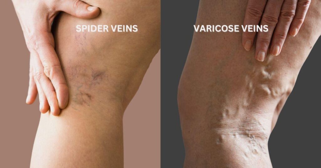 https://www.varisesindonesia.id/images/blog/BLOG__spider-vein-vs-varises-mirip-tapi-bedanya-bisa-fatal-kalau-salah-dianggap__20260724012656.jpg